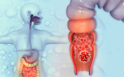 Colorectal Cancer Screening & Treatment - Vipulroy Rathod Colorectal-Cancer