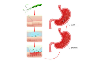 Gastritis and Peptic Ulcers - Vipulroy Rathod Gastritis-and-Peptic-Ulcers