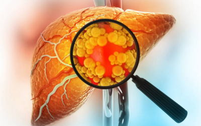 Hepatitis and Liver Cirrhosis - Vipulroy Rathod Hepatitis-and-Liver-Cirrhosis