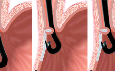 Antireflux_Mucoplasty