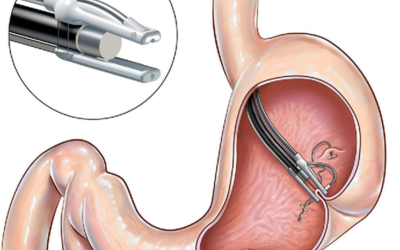 Endoscopic_Suturing_Techniques