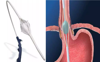 Stretta_Procedure