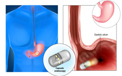 Capsule Endoscopy for Crohns Disease - Vipulroy Rathod