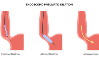 Endoscopic Balloon Dilation - Vipulroy Rathod