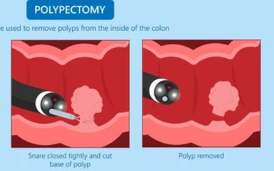 Argon Plasma Coagulation (APC) for Bleeding Control Treatment in Mumbai ...