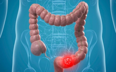 Colorectal Cancer 1 - Vipulroy Rathod