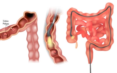 ·        Early Gastrointestinal Cancers
