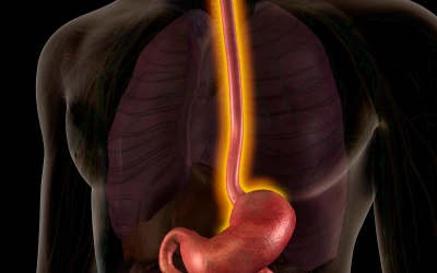Esophageal Cancer - Vipulroy Rathod