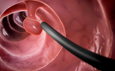 Large Polyps and Growths