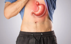 Hiatal Hernia