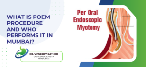 What Is POEM Procedure and Who Performs It in Mumbai?