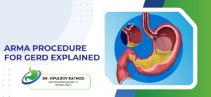 ARMA Procedure for GERD Explained