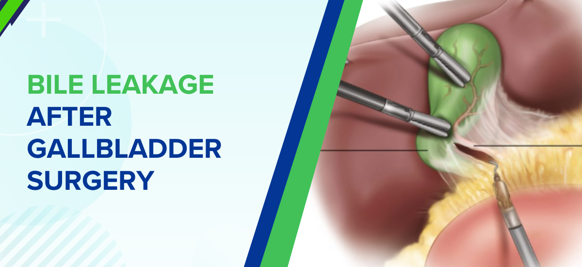Bile Leakage After Gallbladder Surgery: Causes, Symptoms, and Treatment