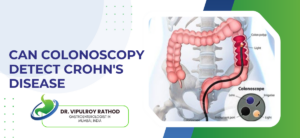 Can Colonoscopy Detect Crohn’s Disease