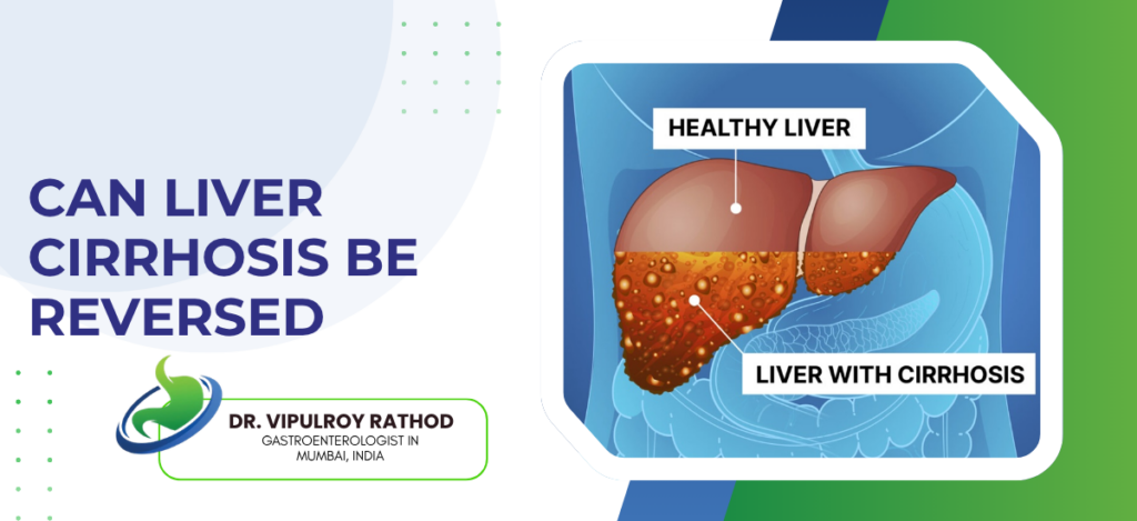 Informational slide about reversing liver cirrhosis; graphic shows healthy liver vs cirrhotic liver labeled accordingly, with doctor’s name and specialty.