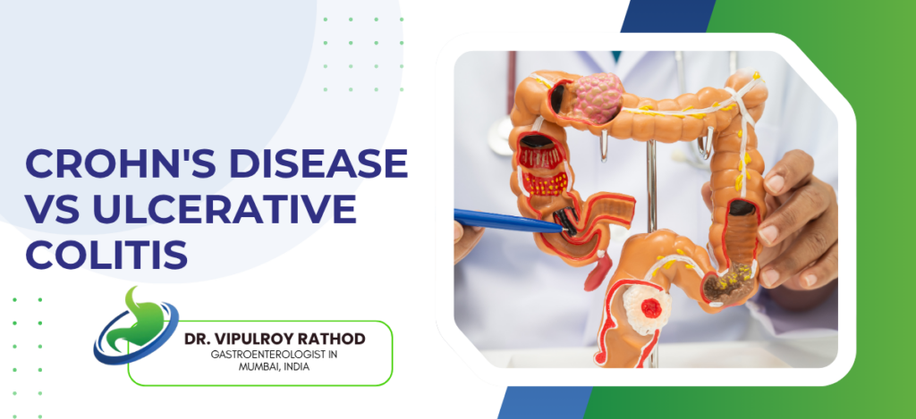 Banner slide: Crohn's Disease vs Ulcerative Colitis with a doctor explaining using a large anatomically detailed colon model on a white-framed board.