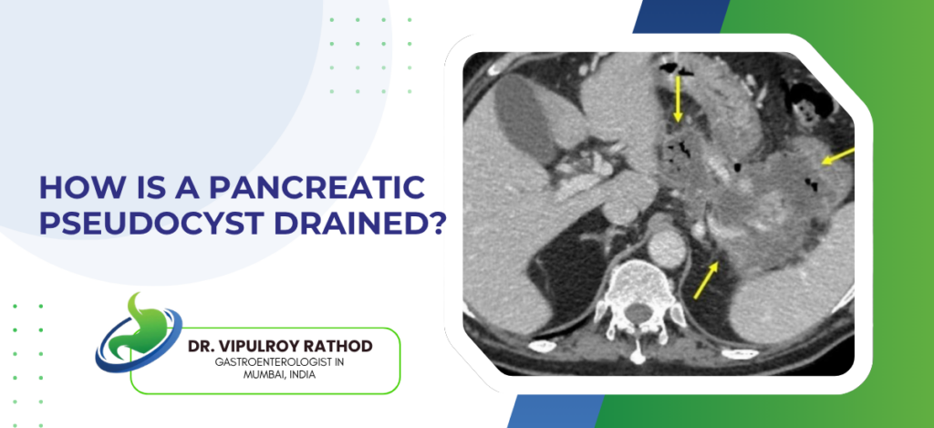 How Is a Pancreatic Pseudocyst Drained?