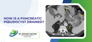 How Is a Pancreatic Pseudocyst Drained?
