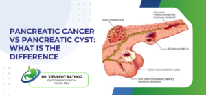 Pancreatic Cancer vs Pancreatic Cyst: What Is the Difference