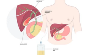 Percutaneous Drainage