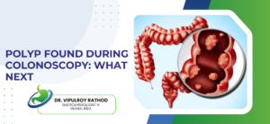 Polyp Found During Colonoscopy: What Next