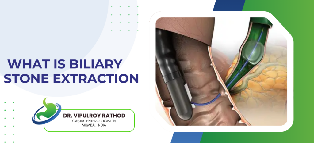 Banner about biliary stone extraction featuring a doctor and endoscopic procedure illustration; title text reads 'What is biliary stone extraction'.