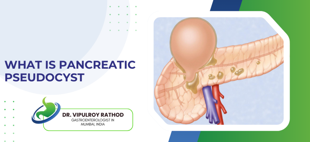 Educational banner titled 'What is pancreatic pseudocyst' with a detailed pancreas illustration and a doctor’s credential badge on the left side.