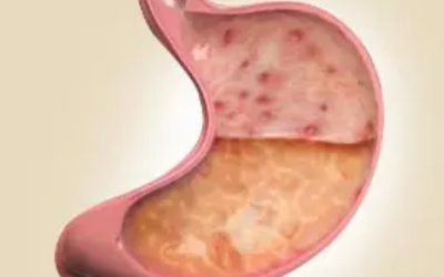 Functional Dyspepsia