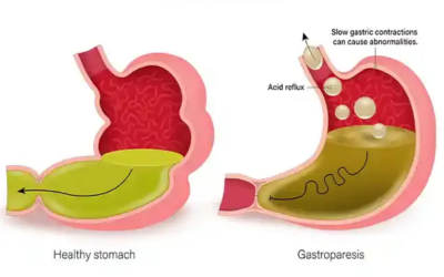 Gastroparesis