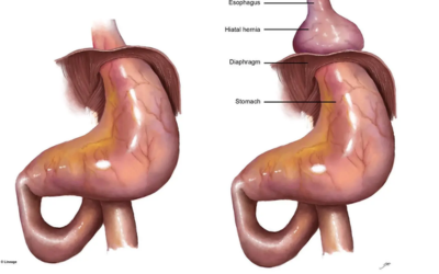 Hiatal Hernia