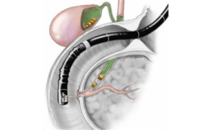 Endoscopic Treatment (ERCP)