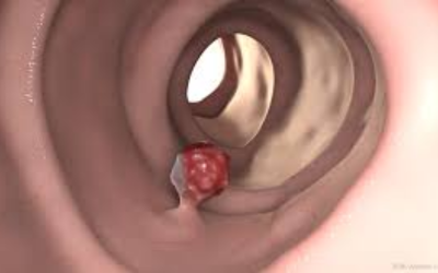 Endoscopic view of a small red polyp-like mass attached to the inner wall of a tubular organ.