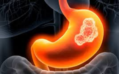 Illustration of a human stomach with a highlighted tumor indicating stomach cancer.