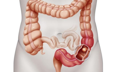 Diagram of the digestive system focusing on the large intestine with a highlighted cancerous tumor in the sigmoid colon.