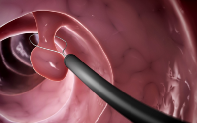Endoscopic snare loop around a polyp inside a pink intestinal lumen (colonoscopy scene)