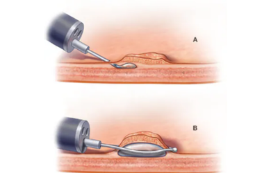 Two-panel medical illustration showing a handheld device applying energy to skin: (A) a probe directly contacts a raised skin area; (B) the device interfaces with the tissue using a suction-assisted head to lift the skin.