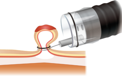 Syringe with a fine needle injecting into a hair follicle beneath the skin.