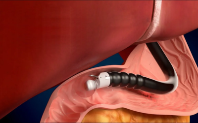 Close-up medical illustration of a flexible catheter or probe inserted into pink tissue with a white-tipped end and a black, segmented body
