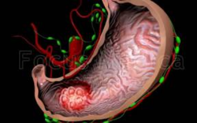 Illustration of a human stomach cross-section showing a red, irregular tumor on the inner lining, indicating gastric cancer.