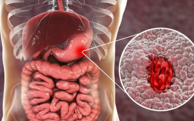 Medical illustration of the digestive system with a magnified inset showing a narrowed artery with a red blood clot (atherosclerotic plaque).