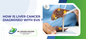 How Is Liver Cancer Diagnosed with EUS?