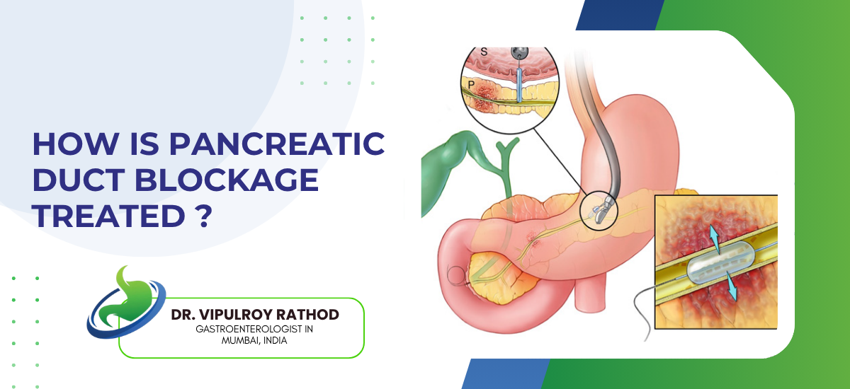 How Is Pancreatic Duct Blockage Treated?