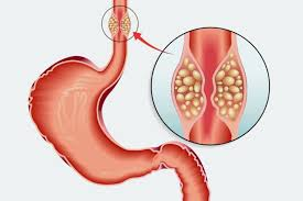 Medical diagram of the stomach and esophagus with a magnified inset showing small yellow polyps on the lining.