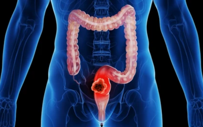 Medical illustration of the large intestine showing a cancerous tumor in the rectum, highlighting colorectal cancer.