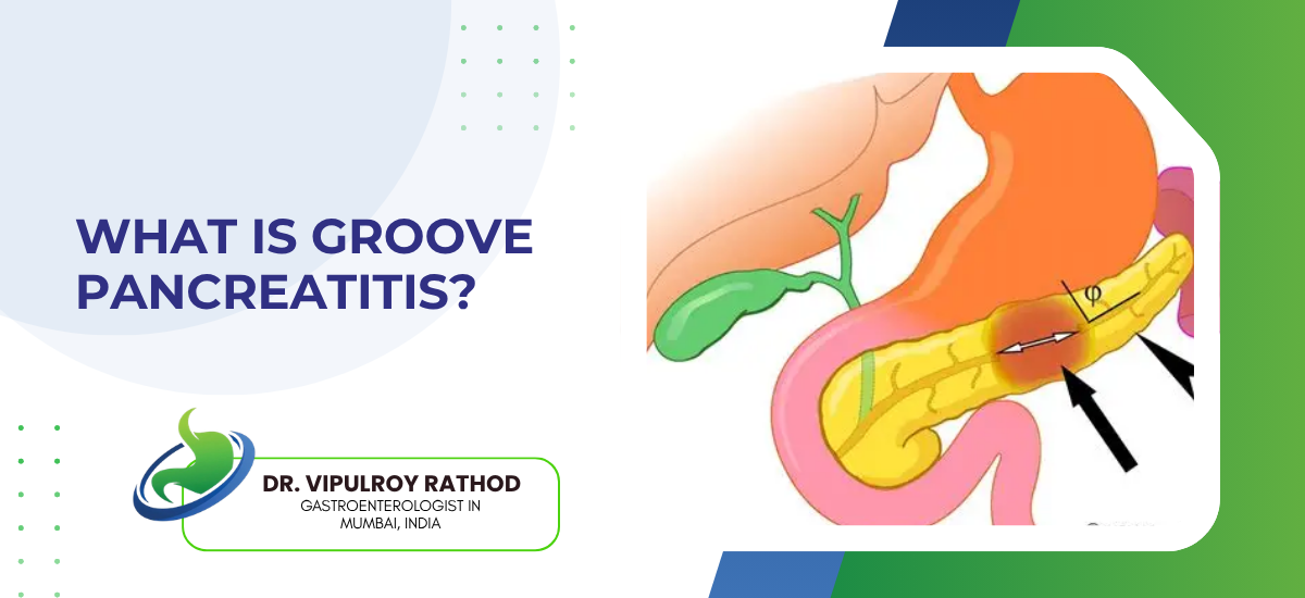 What Is Groove Pancreatitis?