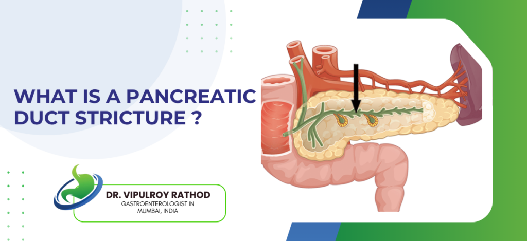 Educational banner about pancreatic duct stricture featuring a pancreas illustration with ducts and a title question about the condition.