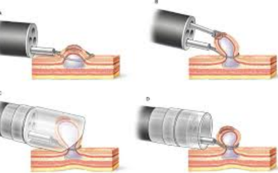 Catheter with deflated balloon approaching a narrowed artery, stent ready to deploy.