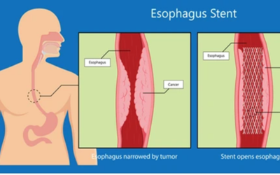Educational diagram of the esophagus in a person: left panel shows tumor narrowing the esophagus; right panel shows a stent expanding the passage to relieve the blockage.