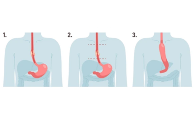 Three-panel diagram showing the path of a swallowed bolus from esophagus into the stomach: panel 1 shows the esophagus connecting to the stomach; panel 2 shows the bolus moving down the esophagus toward the stomach; panel 3 shows the bolus inside the stomach with the esophagus continuing upward.