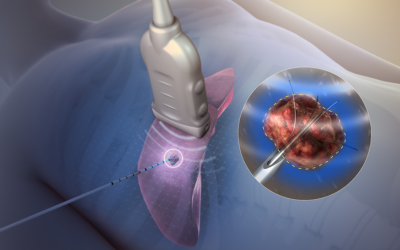 Medical illustration of a minimally invasive tumor ablation: a probe inserted into tissue with a highlighted pink area and a circular inset showing a tumor being targeted by a needle-like instrument.